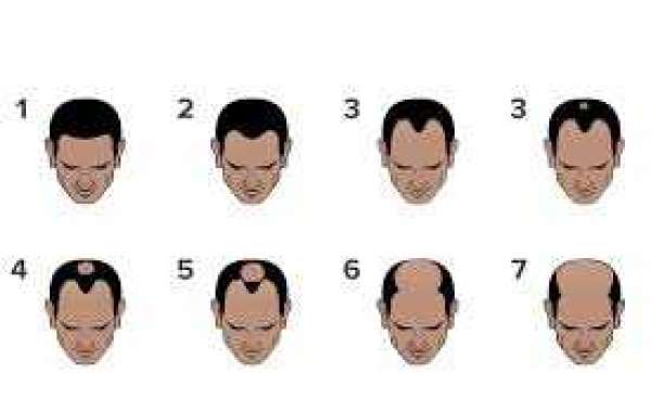 Stage 1 Hair Loss Treatment