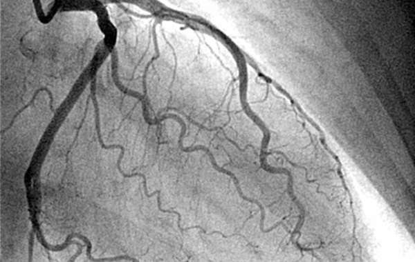 Understanding Coronary Angiography in Jaipur