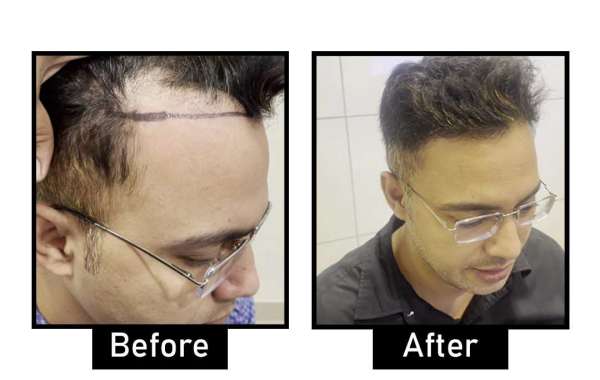 Best Hair Doctor in South Delhi: Expert Solutions for Hair Loss